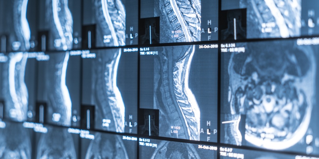 Knochenkrebs Endstadium