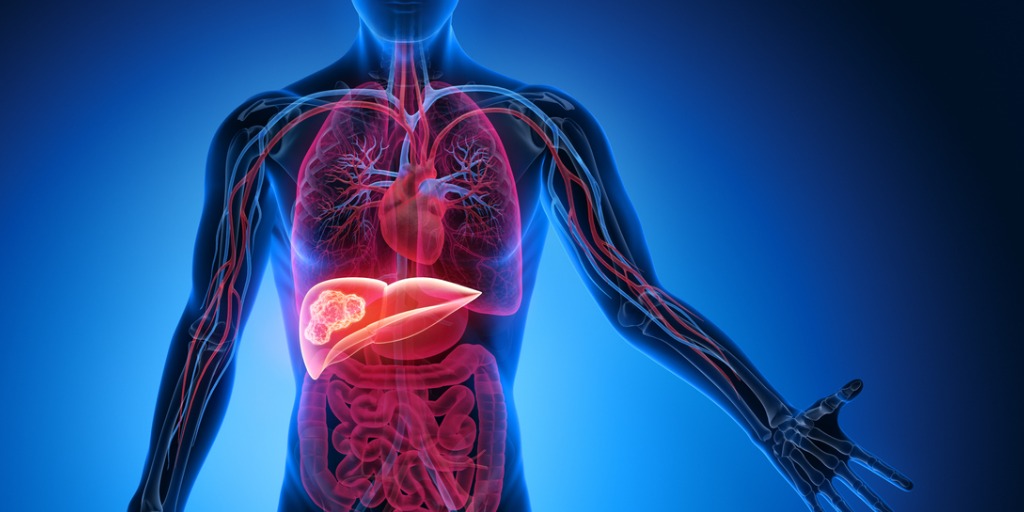 Anzeichen Leberkrebs Endstadium