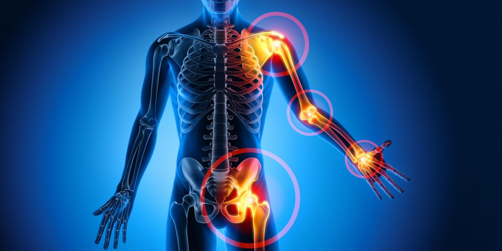 Rheuma der Körper in Flammen mediorbis