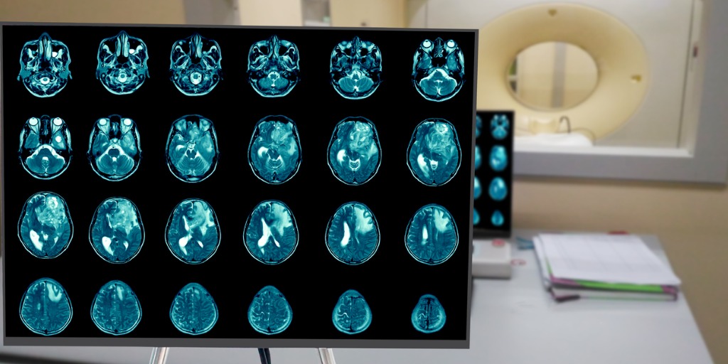 schlimmster Krebs; Glioblastom