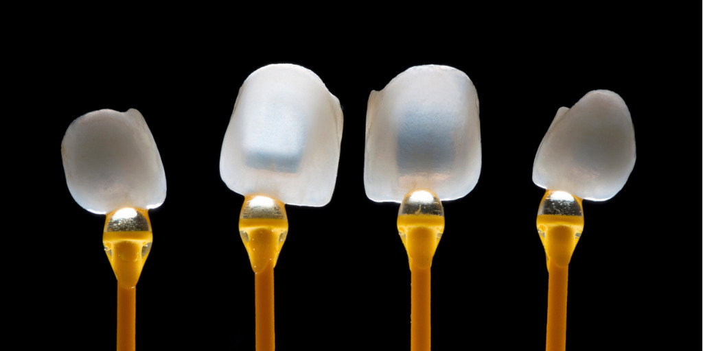 Vier Veneers im Durchlicht zum Thema "Was kosten Veneers?"